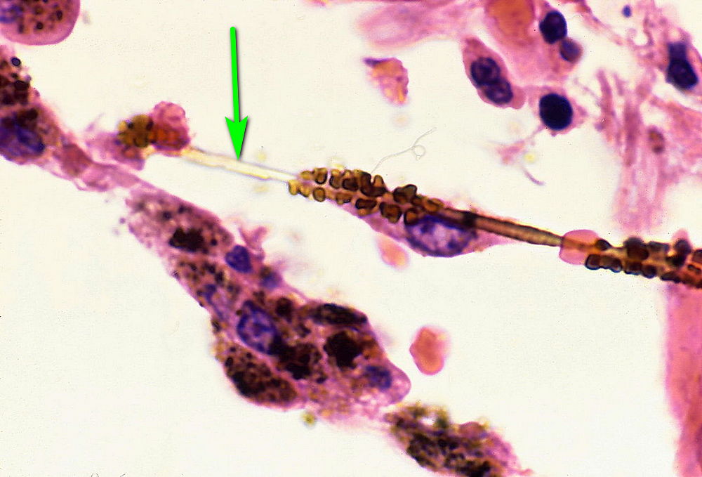 Микроскопическое асбестовое волокно в легочной ткани